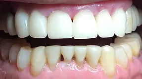 After full mouth rehabilitation: restored, even smile