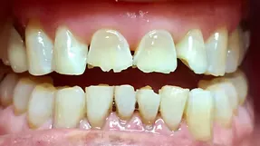 Before full mouth rehabilitation: discolored and damaged teeth