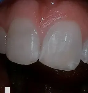 After cosmetic bonding: repaired, bright smile