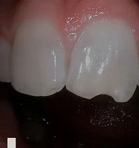 Before cosmetic bonding: worn and discolored front teeth