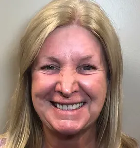 After implant-supported dentures: healthy, complete smile