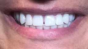After All-on-4: full-arch implant restoration
