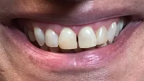 Before All-on-4: severely compromised dentition