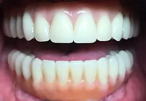 After cosmetic treatment: natural, even smile