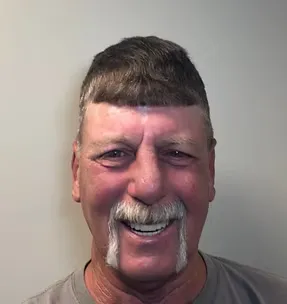 After All-on-4: permanently restored full arch