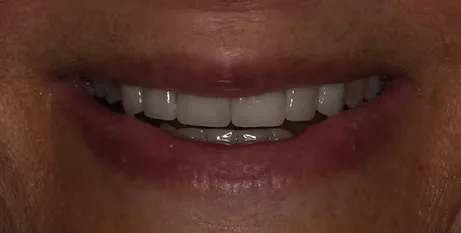 After veneers: even, natural-looking smile