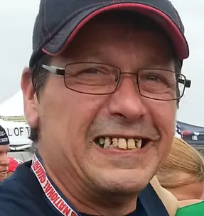 Before traditional dentures: missing or failing teeth