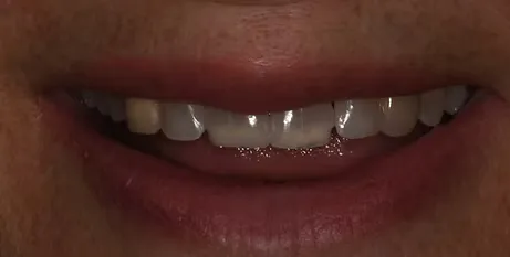 Before veneers: chipped and uneven front teeth