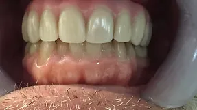 After All-on-4 treatment: full arch of natural-looking teeth