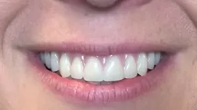 After All-on-4: restored full arch