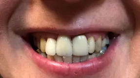 Before All-on-4: worn or failing teeth