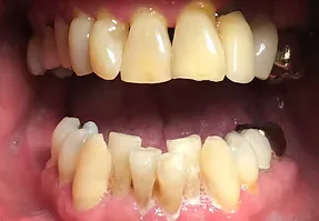 Before cosmetic treatment: stained or chipped teeth