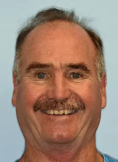 Before full mouth rehabilitation and veneers: smile before treatment