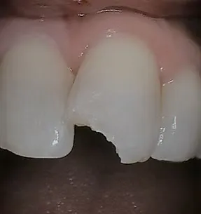 Before cosmetic bonding: chipped front tooth