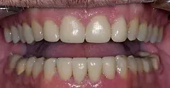 After full mouth rehabilitation and veneers: restored, uniform smile