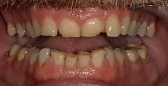 Before full mouth rehabilitation and veneers: worn, chipped, and crowded teeth