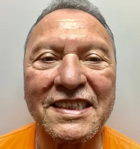 Before full mouth rehabilitation and veneers: patient smile before treatment