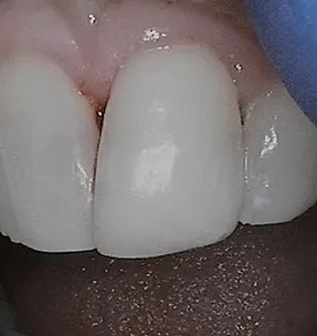 After cosmetic bonding: chipped tooth repaired with composite filling