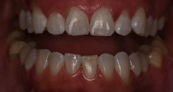 After K&ouml;R&reg; Whitening: noticeably brighter, whiter teeth