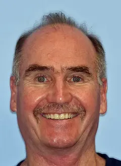 After full mouth rehabilitation and veneers: restored smile