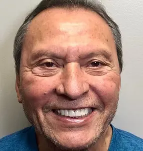 After full mouth rehabilitation and veneers: patient smile after treatment