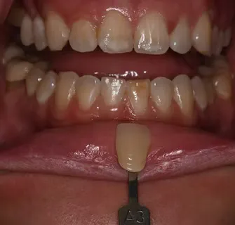 Before K&ouml;R&reg; Whitening: shade guide showing tooth color prior to treatment